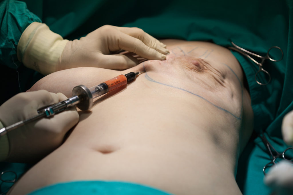 female breast surgeon in hyderabad
