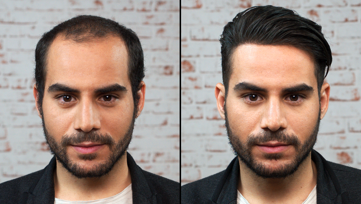 hair transplant surgery in hyderabad