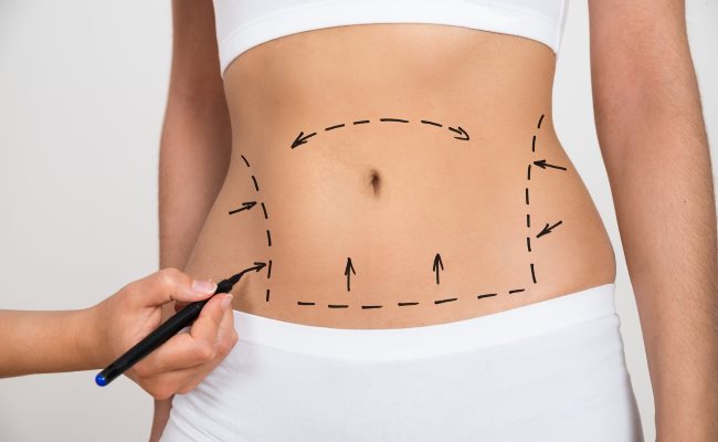 tummy tuck surgeon in hyderabad